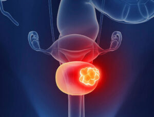 İdrarındaki Kanamayı Önemseyince Mesane Tümörü Erken Teşhis Edildi