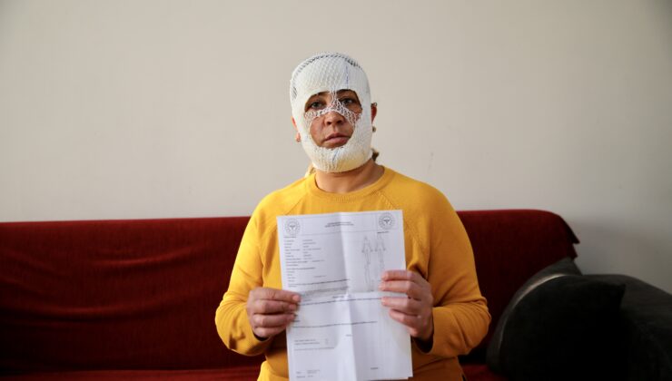 Adana’da Cilt Bakımı Sonrası Yüzünde 2.Derece Yanık Oluşan Kadın Şikayetçi Oldu